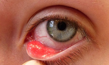 Лечение внутреннего ячменя на глазу